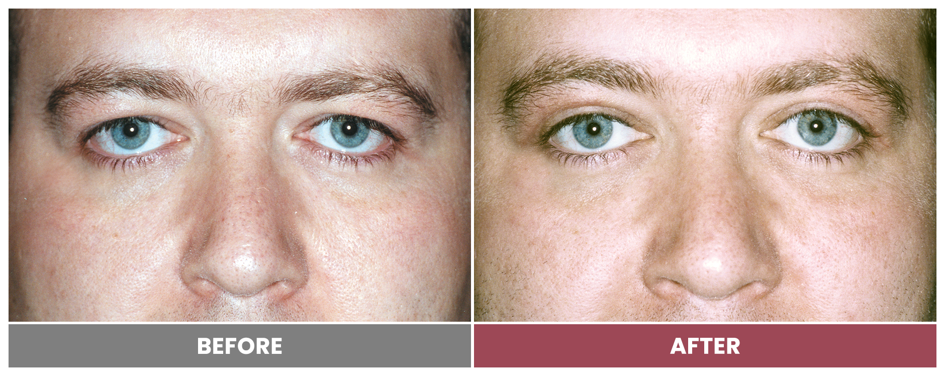 Upper Blepharoplasty - Case 42